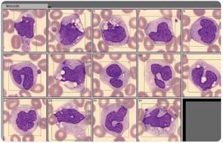 Bringing hematology testing to the point of care – the history of Boule ...