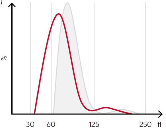 side-by-side comparison showing deviation from first RBC blood cell histogram and indicating a specific condition