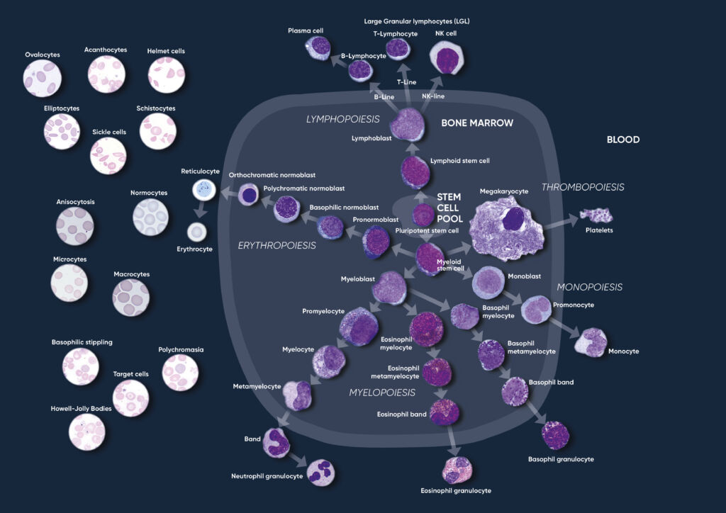 CBC in infectious diseases - Boule