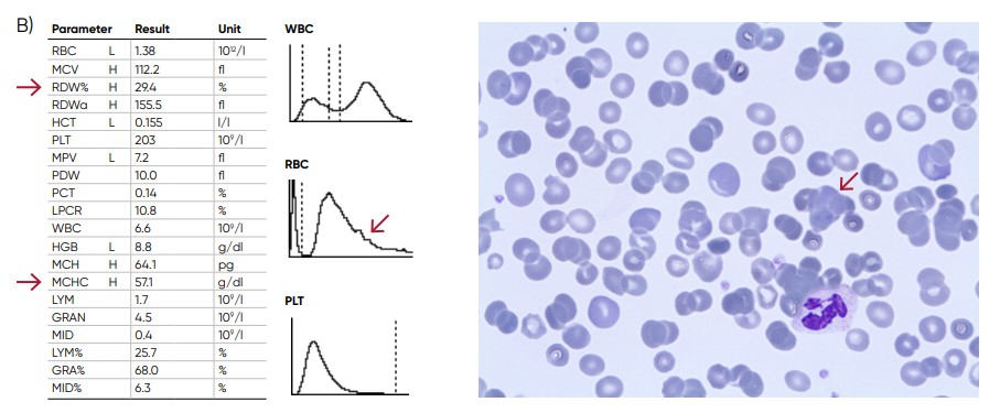 Possible causes of an RBC histogram showing an abnormal high at the upper discriminator can be RBC agglutination