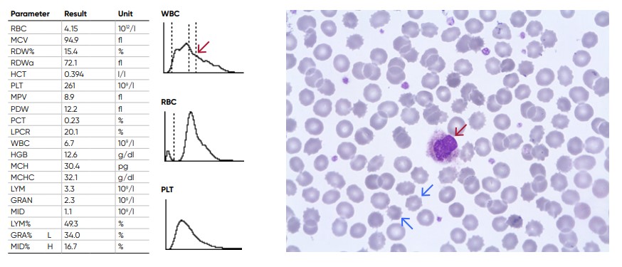 Old sample showing spiny RBCs (blue arrows) and an increase in the proportion of the cells in the MID-region due to shrivelled neutrophils (red arrow)