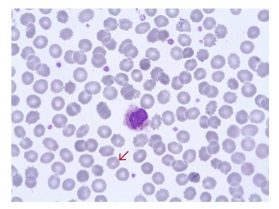 Fig 13. Blood film from a sample that has been stored for too long, showing spiny RBCs (red arrow).