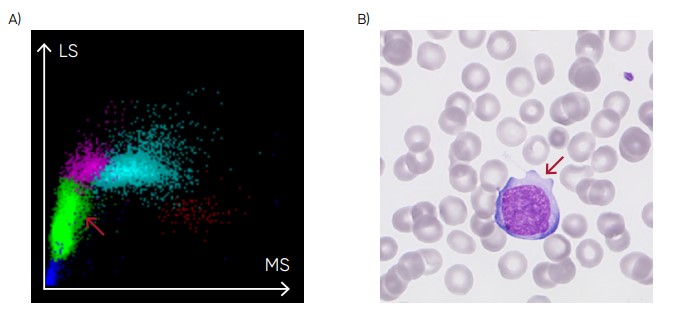 (A) Medonic M51 scattergram with presence of abnormal lymphocytes. (B) Microscopic image of an abnormal lymphocyte