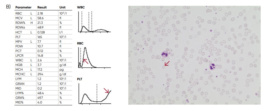 A shift of the RBC histogram to the left gives an indication of microcytic RBCs