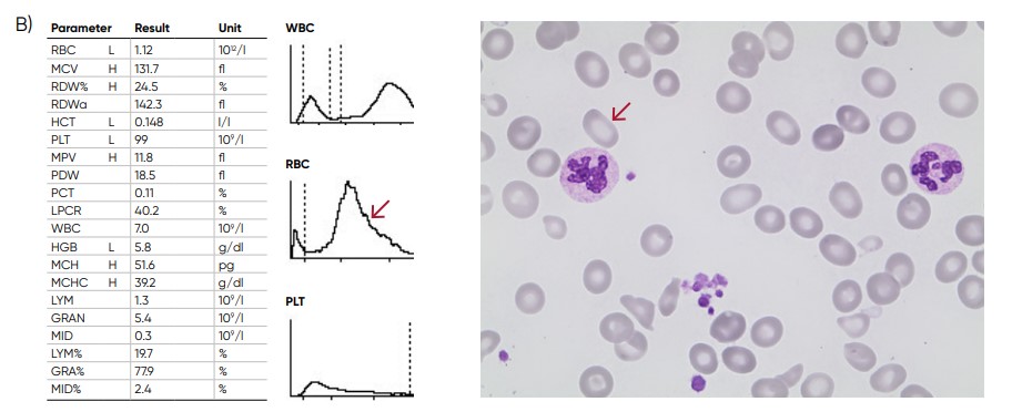 (A) A shift of the RBC histogram to the right gives an indication of macrocytic RBCs (larger than normal). (B) Sample results of vitamin B12 (folic acid)-deficiency anemia, showing macrocytosis (red arrow) and anisocytosis.