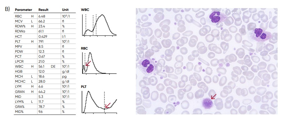 Possible causes of an RBC histogram showing an abnormal high at the lower discriminator can be RBC or WBC fragments, large (giant) PLTs, microcytic RBC, or PLT clumps