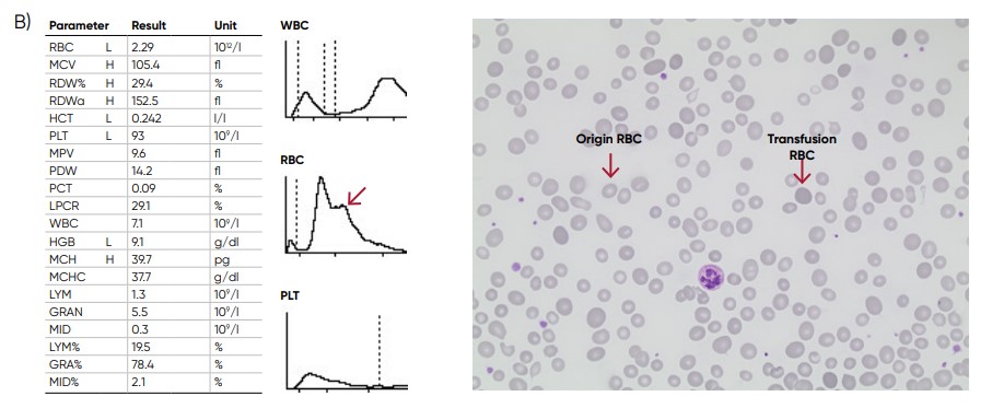  Multiple RBC peaks can be a reflection of iron deficiency in recovery, dual-deficiency anemia (iron and vitamin B12/folic acid), or blood transfusion. 