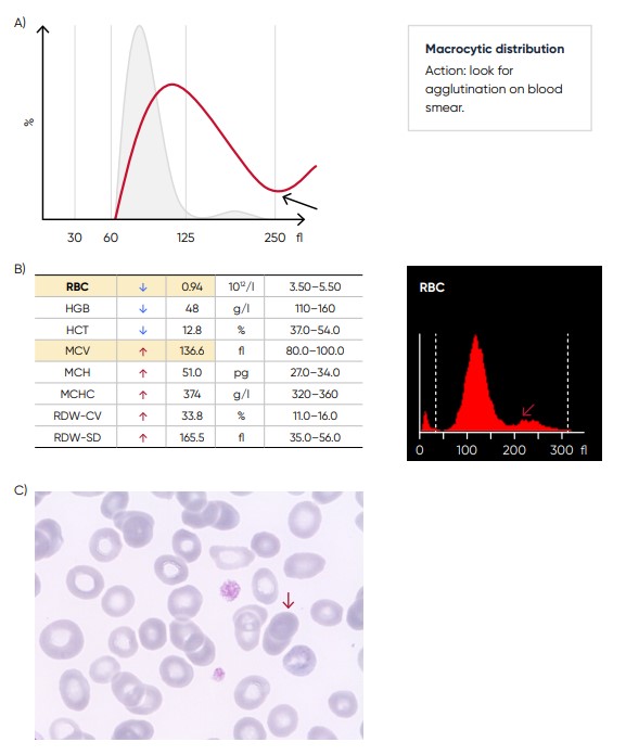 (A)Possible causes of an RBC histogram showing an abnormal high at upper discriminator can be RBC agglutination, cold agglutination, nucleated RBCs, or small LYMs, for example, due to chronic lymphocytic leukemia (CLL). Rule out cold agglutination by warming the sample at 37˚C for 15 min and re-analyze. (B) Medonic M51 results presented in numerical values and histogram from a sample with RBC aggregation (red arrow). (C) Microscopic image of RBC aggregation (red arrow).