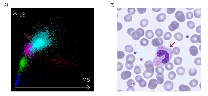  (A) Medonic M51 scattergram showing left shift (presence of band neutrophils). (B) Microscopic image of a band neutrophil.