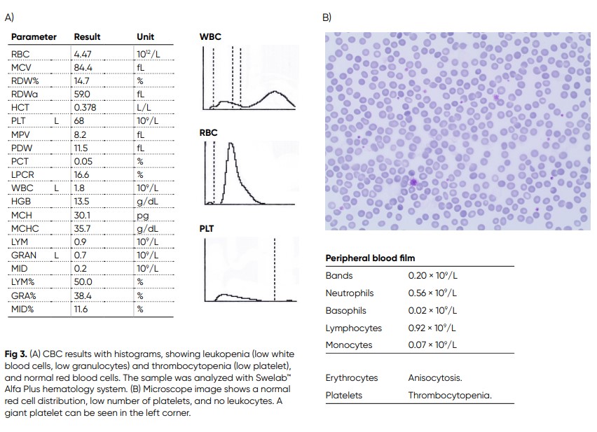 CBC results with histograms, showing leukopenia (low white blood cells, low granulocytes) and thrombocytopenia (low platelet), and normal red blood cells.