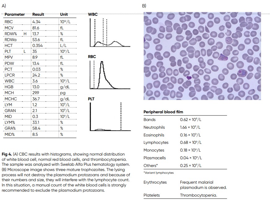  CBC results with histograms, showing normal distribution of white blood cell, normal red blood cells, and thrombocytopenia. 