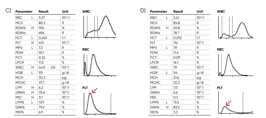  Thrombocytotic and (D) thrombocytopenic samples