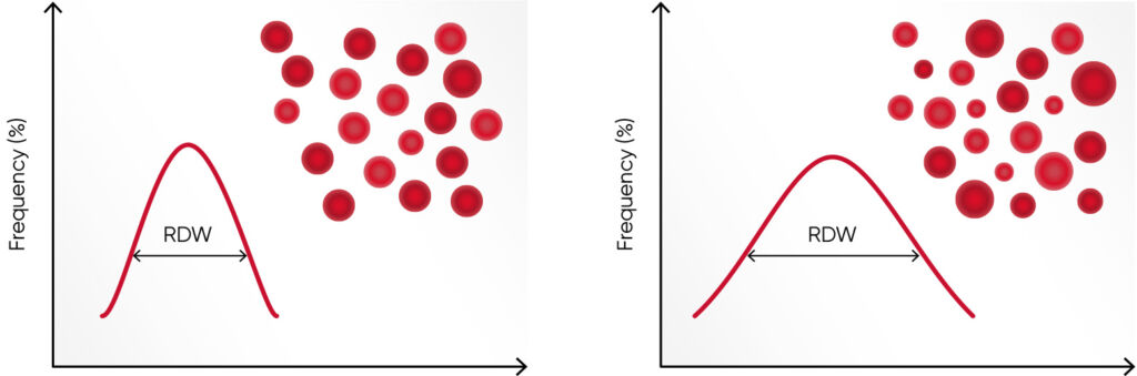 (A) Moderate anisocytosis (RDW 11%–20%). (B) Pronounced anisocytosis (RDW > 20%).