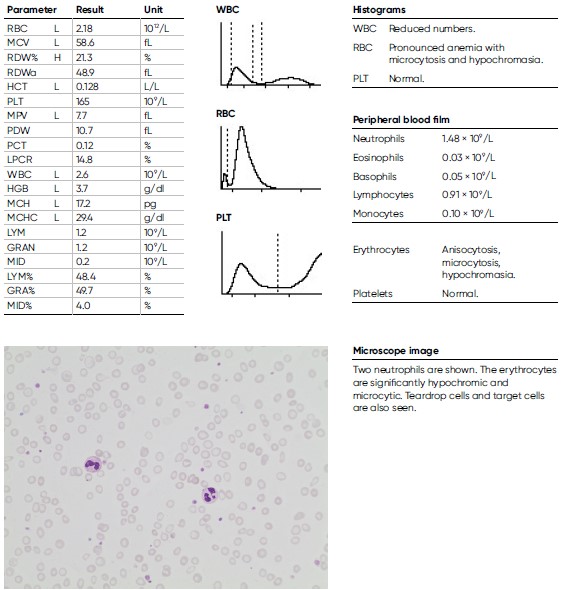 Laboratory findings for a 16-year-old male teenager diagnosed with iron deficiency anemia.