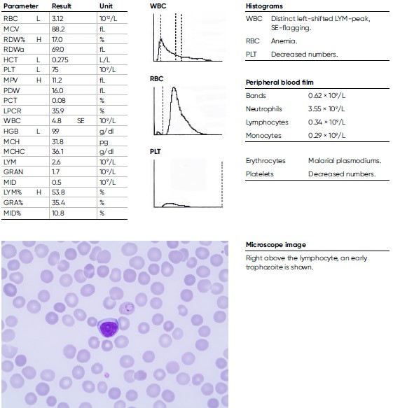Laboratory findings for a 9-year-old male child diagnosed with malaria (P. vivax).