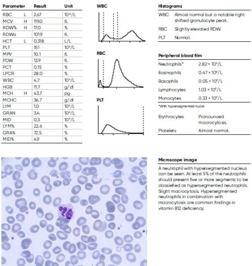 Clinical utility of red blood cell indices in anemia investigations - Boule