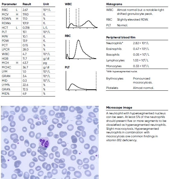 Laboratory findings for a 81-year-old man diagnosed with Pernicious anemia.