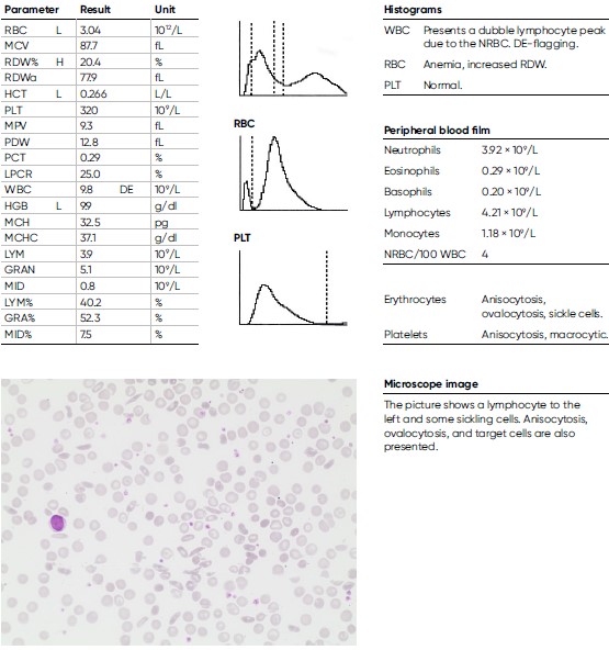 Laboratory findings for a 29-year-old male diagnosed with sickle cell anemia.